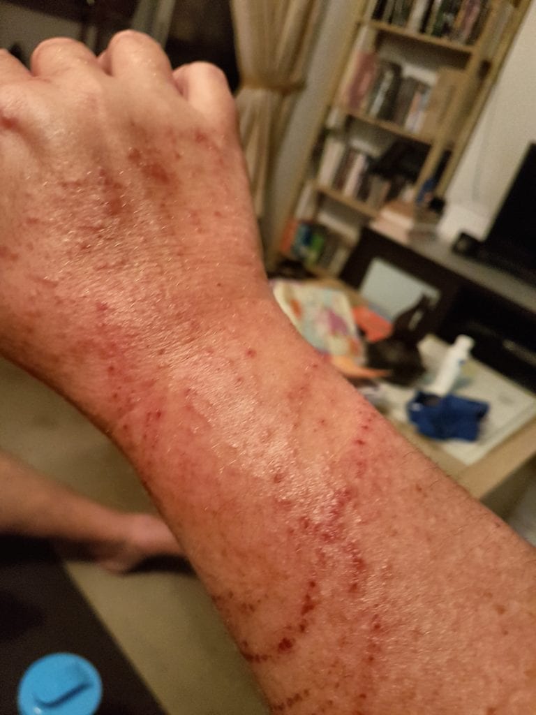 Right forearm after 2 weeks jelly fish sting